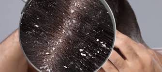 Kepeğe Ne İyi Gelir ?